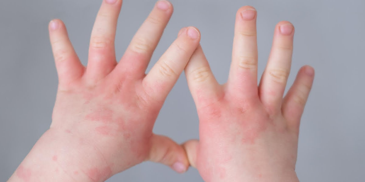Recognize Impetigo in Children, Causes, Symptoms, Treatment, and Prevention